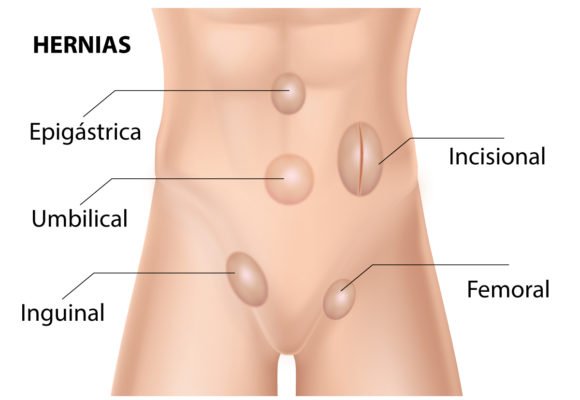 Tipos de hernias