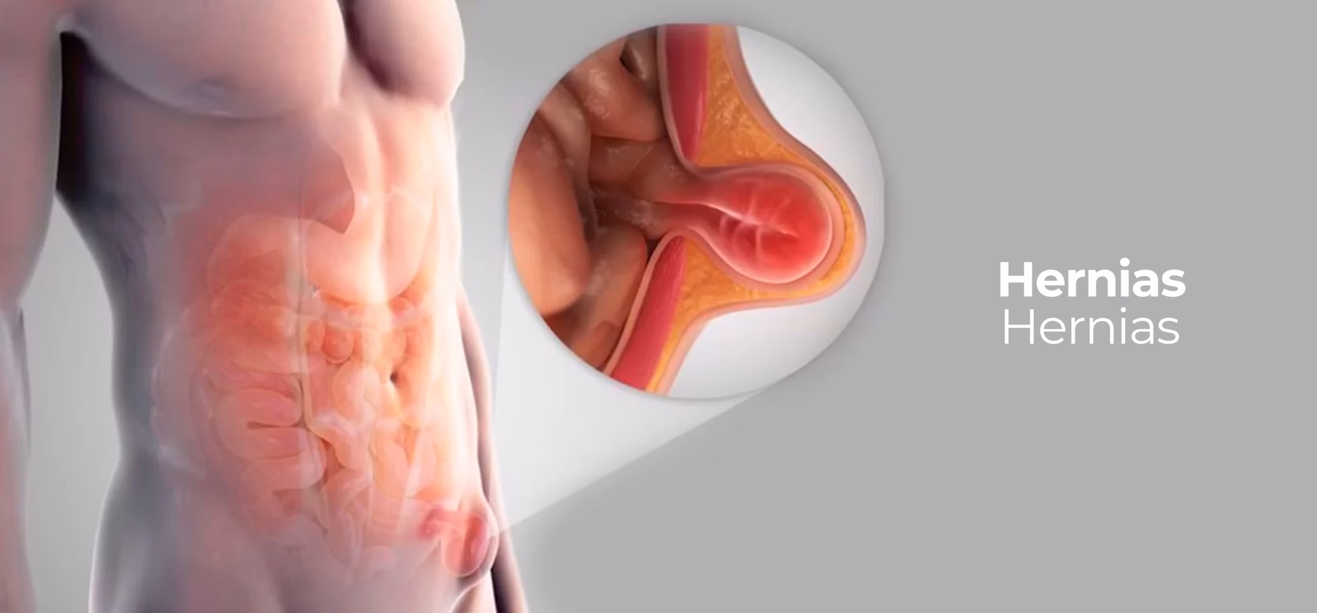 Hernia abdominal
