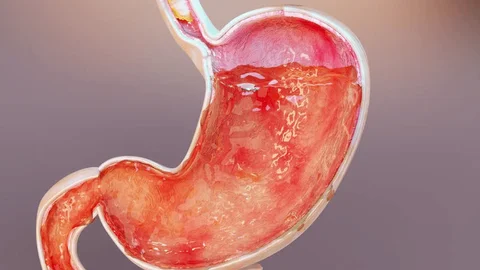 Gastritis