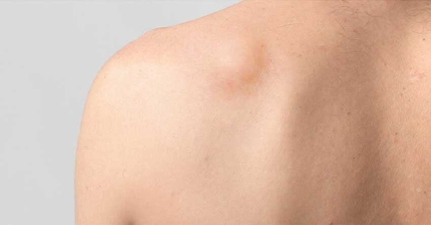 que-es-lipoma Lipoma superficial