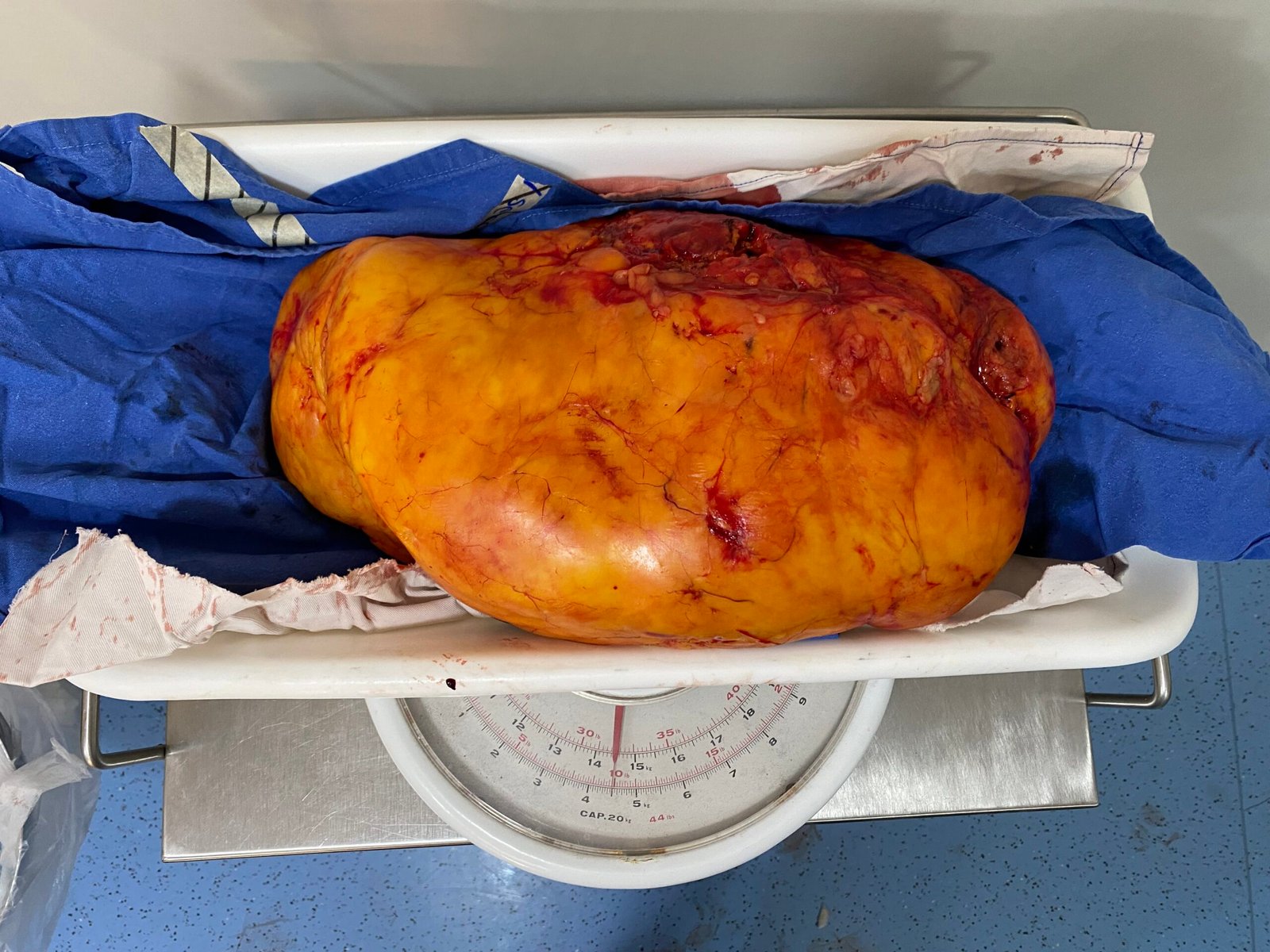 IMG_6443 Lipoma gigante
