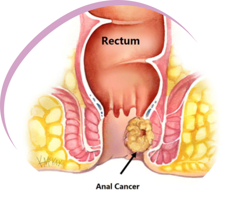 Cancer de ano asociado a VPH